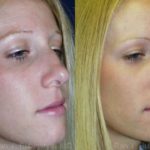 Rhinoplasty Before and After Photos in Newburgh, NY, Patient 13098