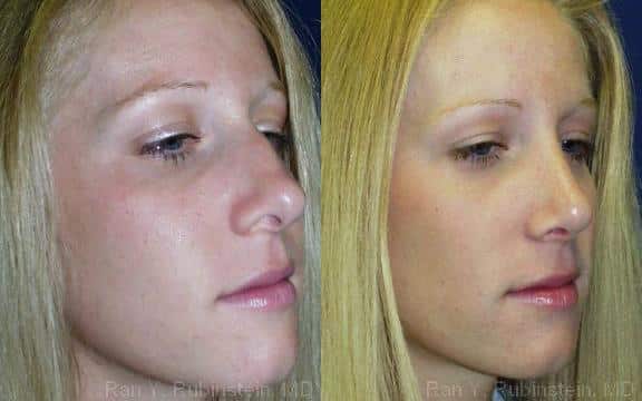 Rhinoplasty Before and After Photos in Newburgh, NY, Patient 13098