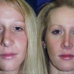 Rhinoplasty Before and After Photos in Newburgh, NY, Patient 13098