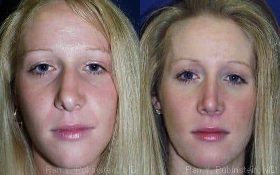 Rhinoplasty Before and After Photos in Newburgh, NY, Patient 13098