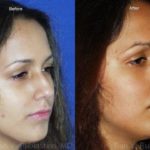 Rhinoplasty Before and After Photos in Newburgh, NY, Patient 13103