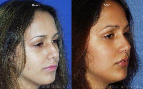 Rhinoplasty Before and After Photos in Newburgh, NY, Patient 13103