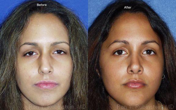 Rhinoplasty Before and After Photos in Newburgh, NY, Patient 13103