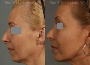 Rhinoplasty Before and After Photos in Montvale, NJ, Patient 13108