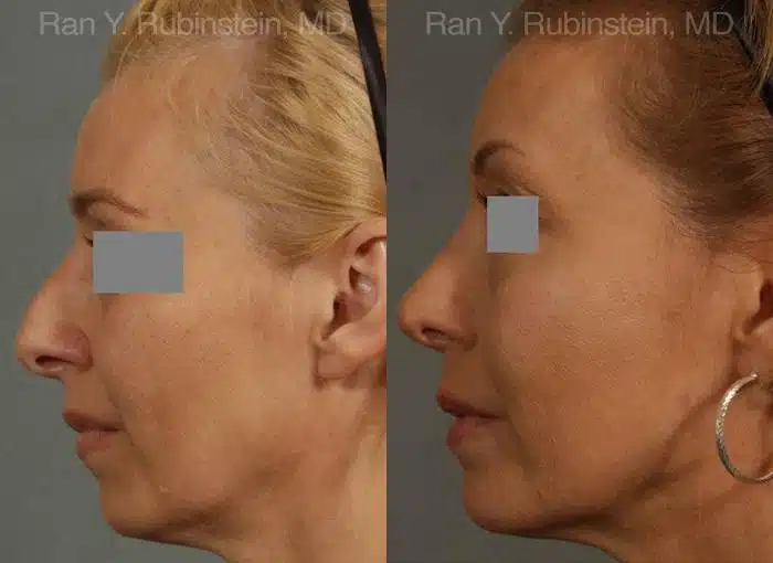 Rhinoplasty Before and After Photos in Newburgh, NY, Patient 13108