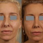 Rhinoplasty Before and After Photos in Newburgh, NY, Patient 13108