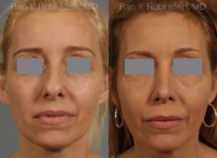 Rhinoplasty Before and After Photos in Newburgh, NY, Patient 13108