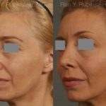 Rhinoplasty Before and After Photos in Newburgh, NY, Patient 13108