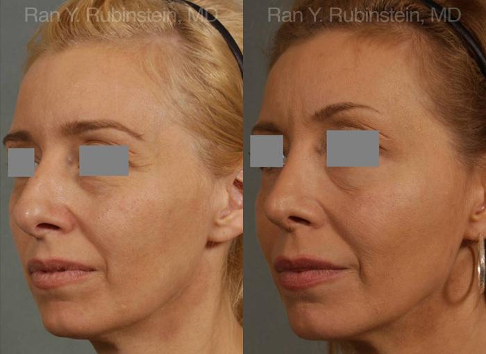 Rhinoplasty Before and After Photos in Newburgh, NY, Patient 13108