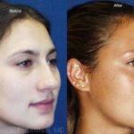 Rhinoplasty Before and After Photos in Newburgh, NY, Patient 13115