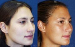 Rhinoplasty Before and After Photos in Newburgh, NY, Patient 13115