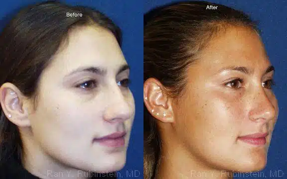 Rhinoplasty Before and After Photos in Newburgh, NY, Patient 13115