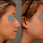 Rhinoplasty Before and After Photos in Newburgh, NY, Patient 13118