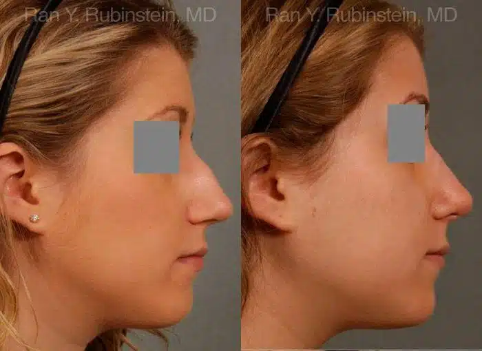 Rhinoplasty Before and After Photos in Newburgh, NY, Patient 13118