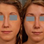 Rhinoplasty Before and After Photos in Newburgh, NY, Patient 13118