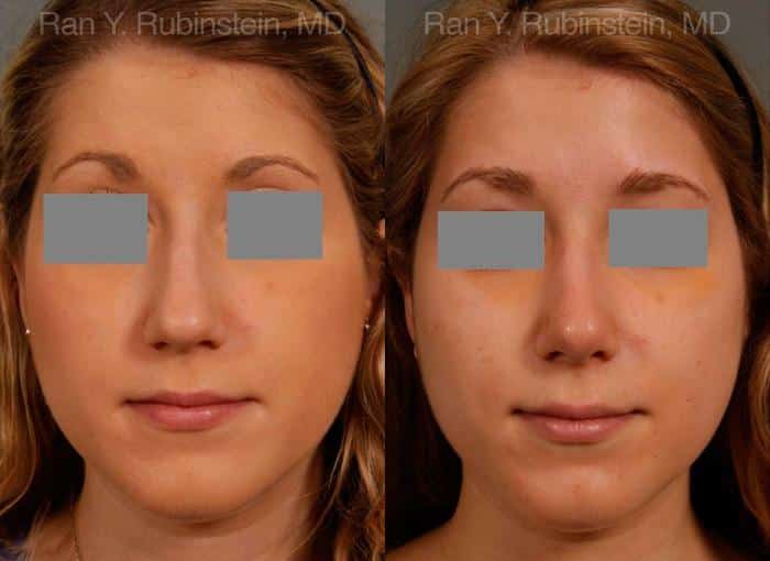 Rhinoplasty Before and After Photos in Newburgh, NY, Patient 13118