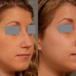 Rhinoplasty Before and After Photos in Newburgh, NY, Patient 13118