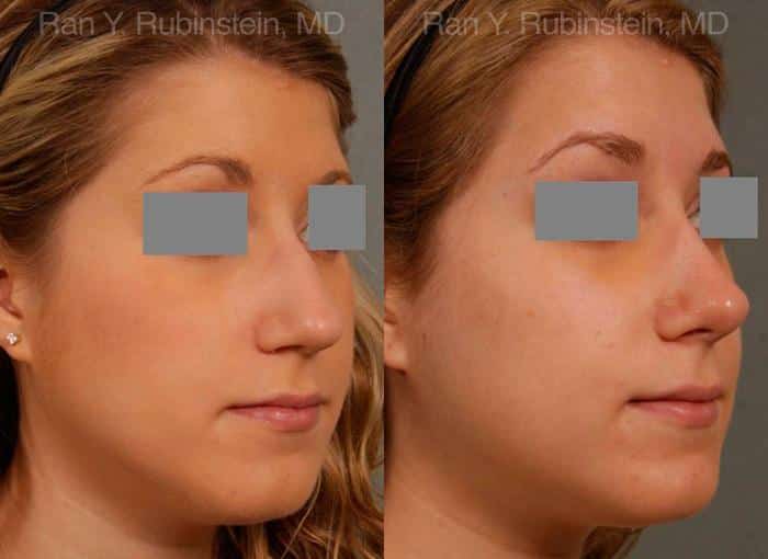 Rhinoplasty Before and After Photos in Newburgh, NY, Patient 13118