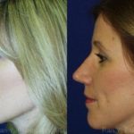 Rhinoplasty Before and After Photos in Newburgh, NY, Patient 13125