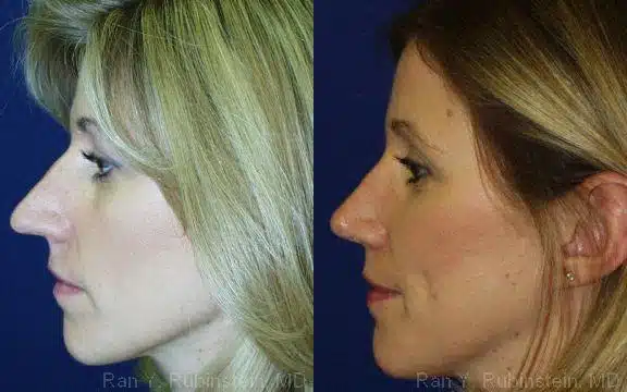 Rhinoplasty Before and After Photos in Newburgh, NY, Patient 13125