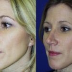 Rhinoplasty Before and After Photos in Newburgh, NY, Patient 13125