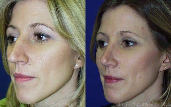 Rhinoplasty Before and After Photos in Newburgh, NY, Patient 13125