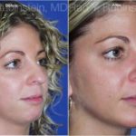 Rhinoplasty Before and After Photos in Newburgh, NY, Patient 13130