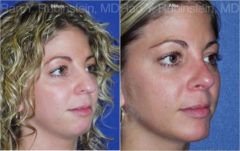 Rhinoplasty Before and After Photos in Newburgh, NY, Patient 13130