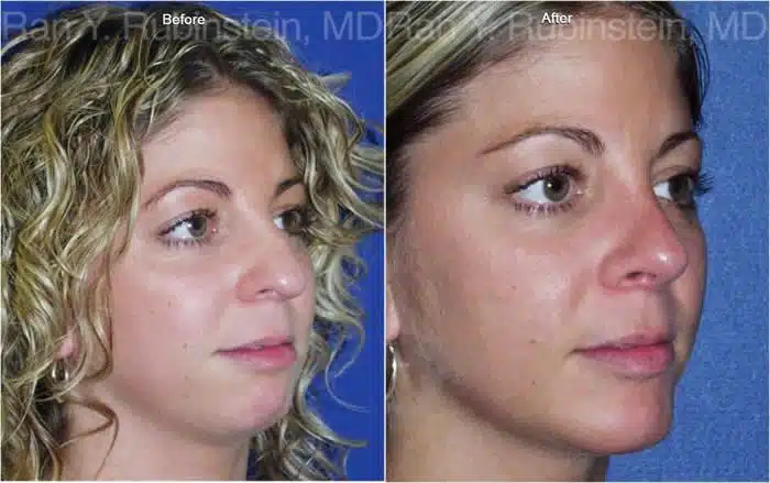 Rhinoplasty Before and After Photos in Newburgh, NY, Patient 13130