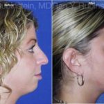 Rhinoplasty Before and After Photos in Newburgh, NY, Patient 13130