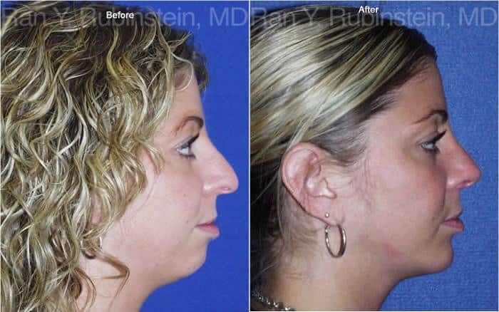 Rhinoplasty Before and After Photos in Newburgh, NY, Patient 13130