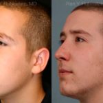 Rhinoplasty Before and After Photos in Newburgh, NY, Patient 13150