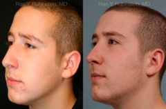 Rhinoplasty Before and After Photos in Newburgh, NY, Patient 13150