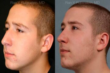 Rhinoplasty Before and After Photos in Montvale, NJ, Patient 13150