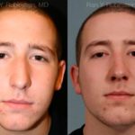 Rhinoplasty Before and After Photos in Newburgh, NY, Patient 13150