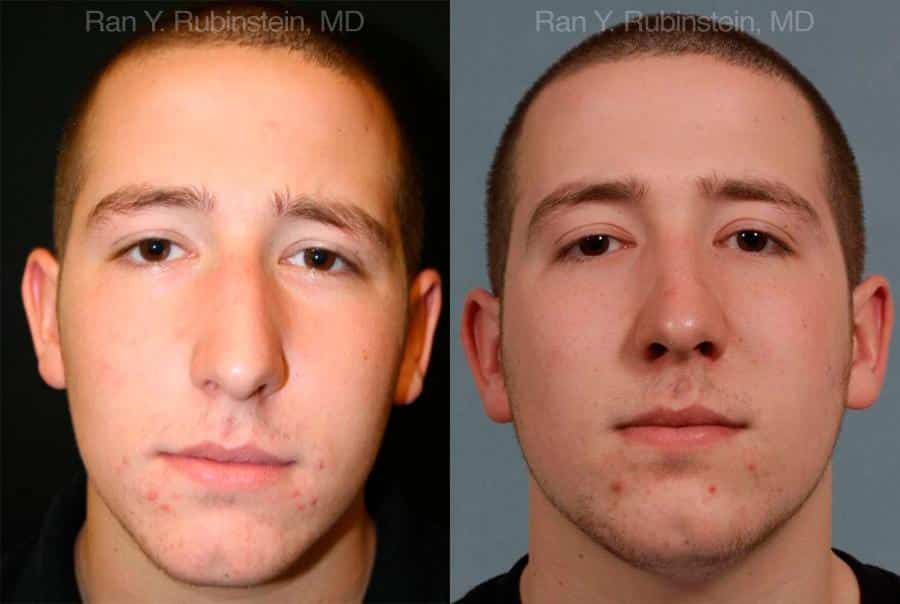 Rhinoplasty Before and After Photos in Newburgh, NY, Patient 13150