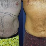 Smart Lipo Body Before and After Photos in Newburgh, NY, Patient 13210