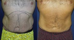 Smart Lipo Body Before and After Photos in Newburgh, NY, Patient 13210