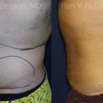 Smart Lipo Body Before and After Photos in Newburgh, NY, Patient 13210