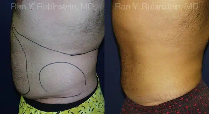 Smart Lipo Body Before and After Photos in Newburgh, NY, Patient 13210