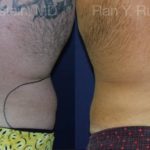 Smart Lipo Body Before and After Photos in Newburgh, NY, Patient 13210