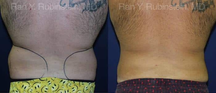 Smart Lipo Body Before and After Photos in Newburgh, NY, Patient 13210