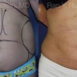 Smart Lipo Body Before and After Photos in Newburgh, NY, Patient 13217