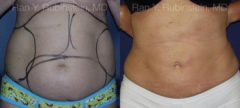 Smart Lipo Body Before and After Photos in Newburgh, NY, Patient 13217