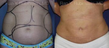 Smart Lipo Body Before and After Photos in Montvale, NJ, Patient 13217