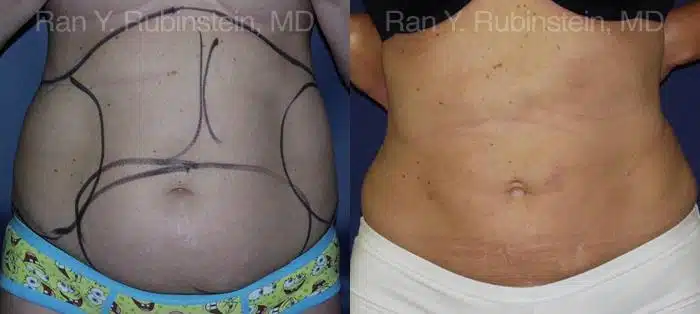 Smart Lipo Body Before and After Photos in Newburgh, NY, Patient 13217