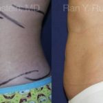 Smart Lipo Body Before and After Photos in Newburgh, NY, Patient 13217