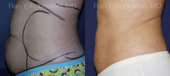 Smart Lipo Body Before and After Photos in Newburgh, NY, Patient 13217