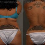 Smart Lipo Body Before and After Photos in Newburgh, NY, Patient 13222