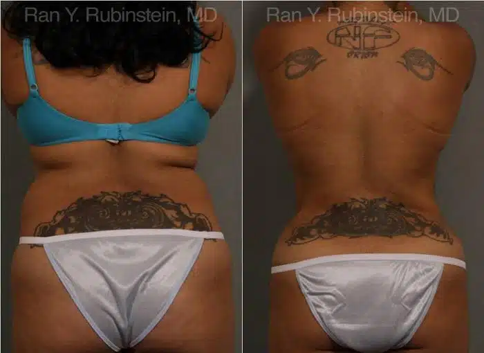 Smart Lipo Body Before and After Photos in Newburgh, NY, Patient 13222